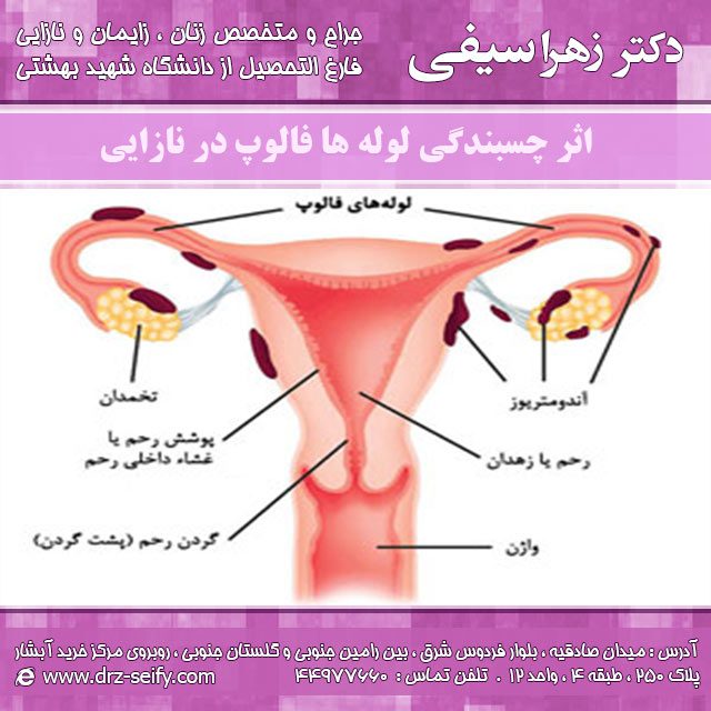اثر چسبندگی لوله ها در نازایی