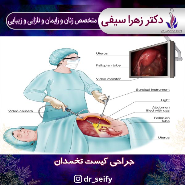 جراحی کیست تخمدان