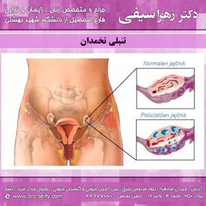 تنبلی تخمدان