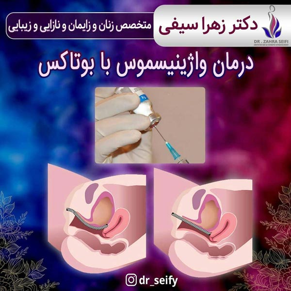 درمان واژینیسموس با بوتاکس