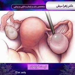 کیست فولیکولار
