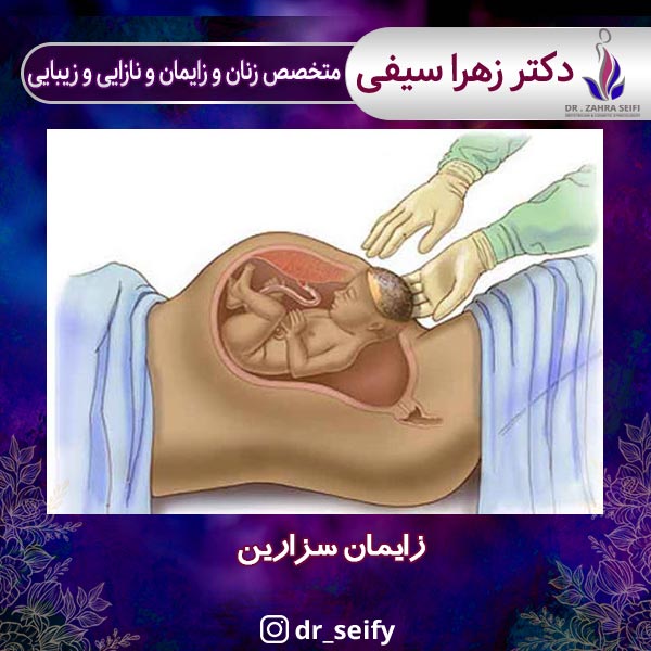 زایمان سزارین