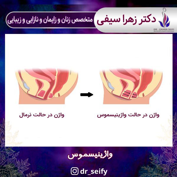 واژینیسموس