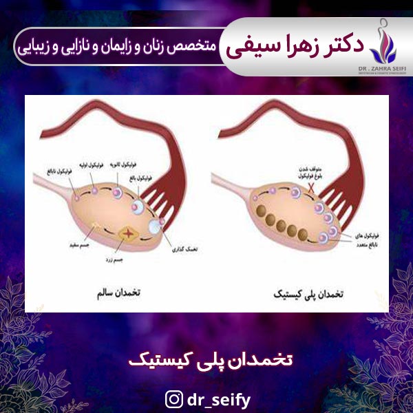 تخمدان پلی کیستیک
